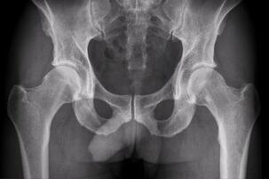Formas de diagnosticar a artrose na articulación da cadeira