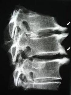 Os osteófitos na columna cervical causan dor no pescozo