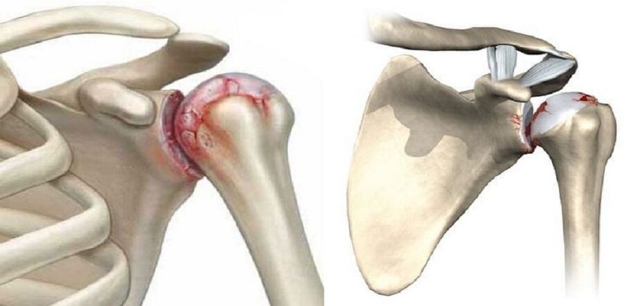 Destrución da articulación do ombreiro na artrose