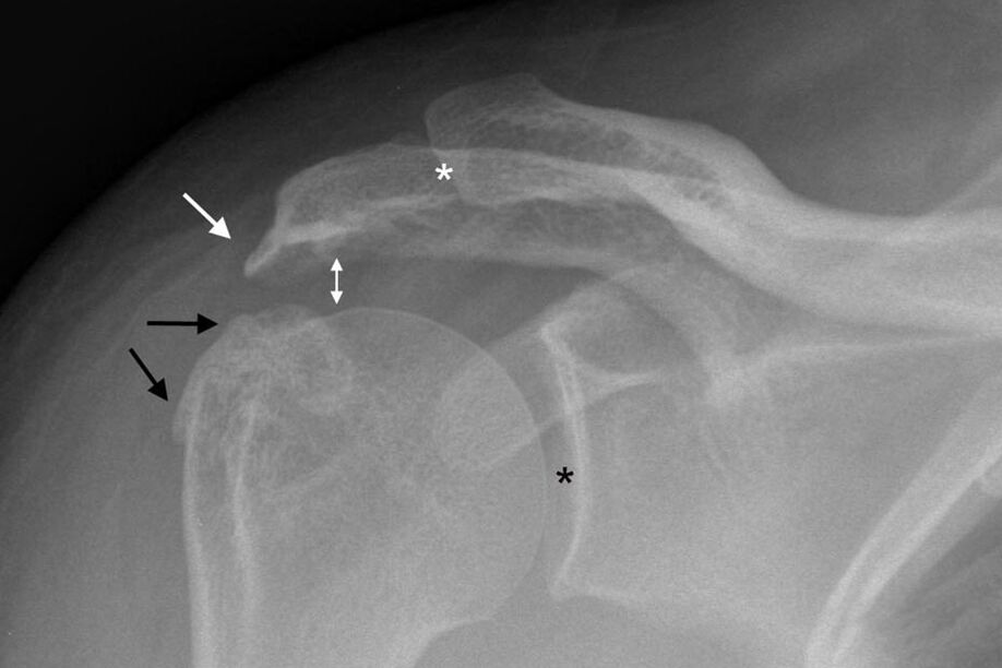 Osteoartrite da articulación do ombreiro na radiografía